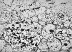 M,3y. | neuroblastoma - adrenal M,3y. | neuroblastoma - adrenal